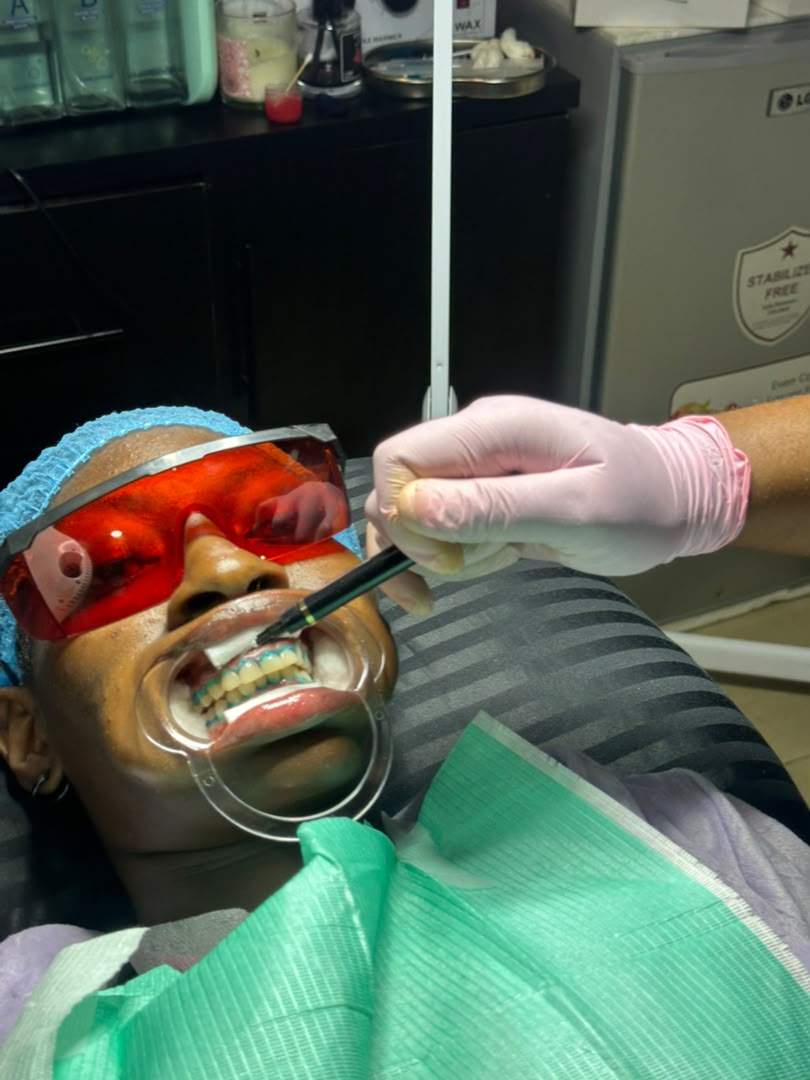 Teeth whitening treatment at TY Beauty Care Spa